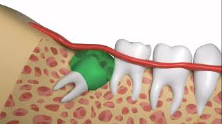 How To Safely and Quickly Have a Wisdom Tooth Extraction [upl. by Aerdnaed]