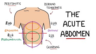 Acute Abdomen  A Guide to Acute Abdominal Pain [upl. by Koball811]