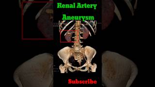 Renal artery aneurysm radiology shorts renalangiography artery education [upl. by Fairleigh]