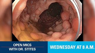 Open Mics with Dr Stites  Familial Adenomatous Polyposis [upl. by Marentic788]