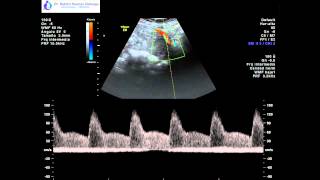 Ecografía Obstétrica Doppler de Arterias Uterinas [upl. by Ainelec]