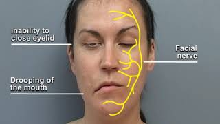 Understanding Facial Palsy [upl. by Seftton]