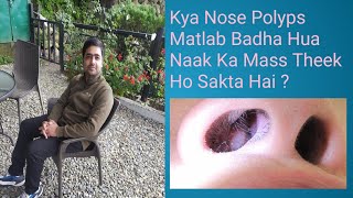 Nose Polyps  Naak Ka Mass Badh Jana Ka Bahut Hi Easy Upchar [upl. by Aynor]