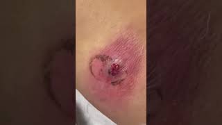 Back abscess with pus [upl. by Hguh]