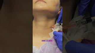 skinbooster  dermalfillers for Neck lines profhilo viscoderm antiagingtreatment skincaretips [upl. by Eirek284]