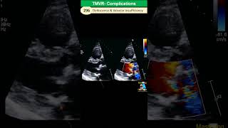 Prosthetic Valve Complications Dehiscence Paravalvular leakage Endocarditis [upl. by Satsoc]