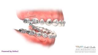 Headgear VS Forsus  Orthodontic Treatment [upl. by Norwood]