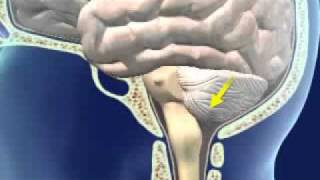 Brainstem Herniation [upl. by Siednarb]