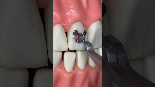 ¡🔥Instalación de BRACKETS 😬 metálicos ÚNICOS🔥 [upl. by Beryle81]