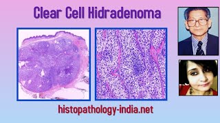 Pathology of Clear Cell Hidradenoma  Dr Sampurna Roy MD dermpath dermatopathology [upl. by Slaby]