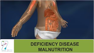 DEFICIENCY DISEASE  MALNUTRITION [upl. by Nivled]