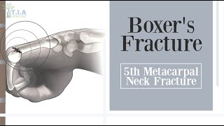 5th metacarpal neck fracture  Boxers Fracture [upl. by Arnold813]