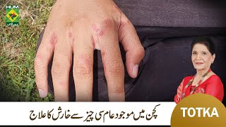 Zubaida Apa Totka  Kharish Khatam Karney ka Gharelu Ilaj  Scabies Infection Treatment  MasalaTv [upl. by Haramat655]