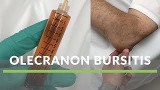 Olecranon Bursitis [upl. by Scheider5]