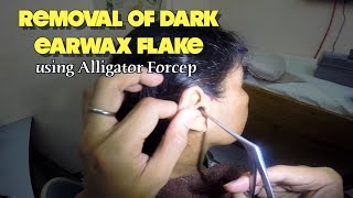 Removal of dark dried earwax flake [upl. by Annoet984]