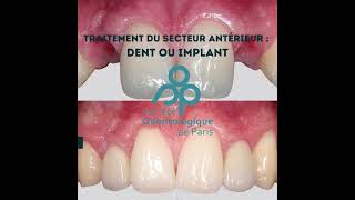 Traitement du secteur antérieur  dent ou implant  par le Pr Serge Armand [upl. by Nehte522]