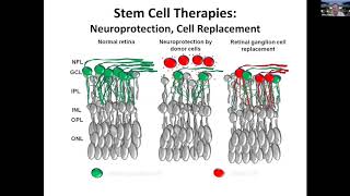 Regeneration and stem cell transplantation as treatment for optic neuropathies [upl. by Ihc]