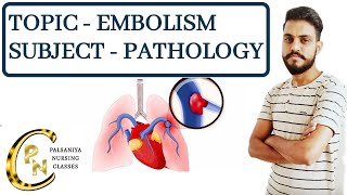 EmbolismDefinitiontypesPathogenesis Clinical manifestations Embolism in hindi by Palsaniya Sir [upl. by Zelten]