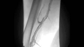 Leg Venographic Images Obtained before and after Thrombolysis [upl. by Nered160]