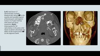 Neurofibromatosis neckㅣfibrous dysplasiaㅣCHARGE syndrome [upl. by Ayocat492]