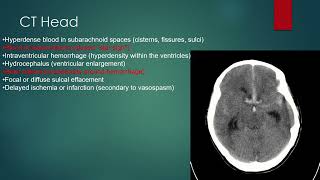 Subarachnoid Hemorrhage [upl. by Follansbee]