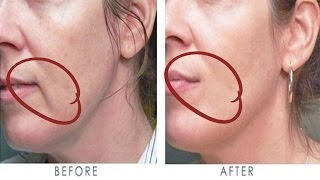 How to get rid of wrinkles above your lips in just few days [upl. by Elysia]