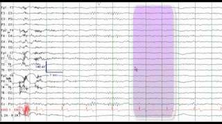 EEG Reading Rounds EEG in Frontal Lobe Epilepsy [upl. by Misty]