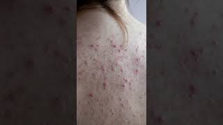 Isotretinion COVID19 Vaccine Interaction Accutane Acne Skin  human science [upl. by Alric395]