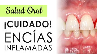 ¡¡CUIDADO CON LAS ENCÍAS INFLAMADAS  CAUSAS Y TRATAMIENTOS [upl. by Neiluj196]