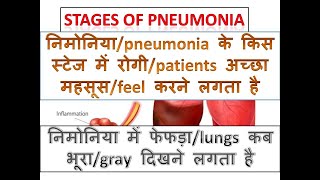 quotनिमोनिया के चरणों का खुलासा लक्षण जिन्हें आपको शीघ्र पहचानना चाहिएquot pneumonia shorts reels [upl. by Vaules]