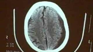 Subdural hematoma [upl. by Irik101]