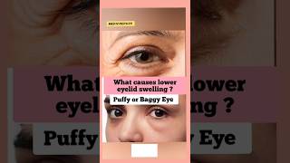 What Causes Puffiness Under Eye [upl. by Eyahs300]