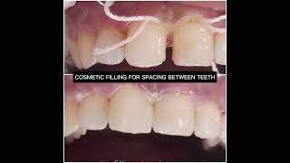 TOOTH COLOR COMPOSITE FILLING TO CLOSE GAP BETWEEN FRONT TEETH [upl. by Hach344]