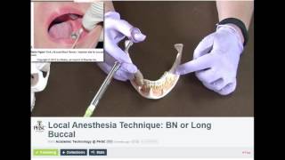 Long Buccal Dental Anesthesia Technique [upl. by Carilla839]