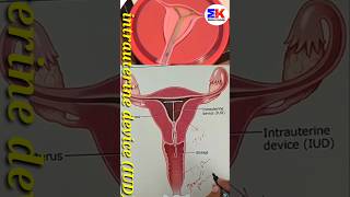 intrauterine device iud medicineknowledgehindi biology shorts [upl. by Latreese]