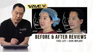 Face Lift Before amp After Review Middle Aged Woman with a Chin Implant  Wave Plastic Surgery [upl. by Olivier668]