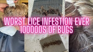 Extremely severe head lice removal [upl. by Callean]