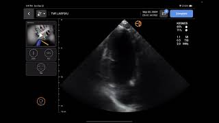 Handheld Ultrasound Review KOSMOS by Echonous [upl. by Llerreg]