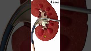 PCNL  Kidney Stone treatment  How kidney stones are removed  Miniperc shortsviral [upl. by Mohr129]