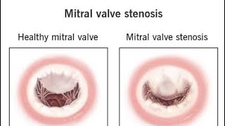 Case Presentation Mitral Stenosis [upl. by Ranique]