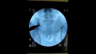 SImmetry Sacroiliac Fusion Bone Graft Insertion [upl. by Alric]