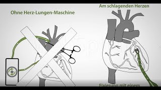 Bypass OP ohne Herz Lungen Maschine [upl. by Amilas11]