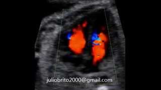 Ecocardiografia fetal 2do trimestre [upl. by Ponzo]