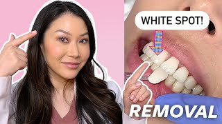 How to Remove WHITE SPOTS on Your Teeth  Dr Joyce Kahng [upl. by Diba210]