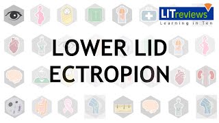 Lower Lid Ectropion [upl. by Litha278]