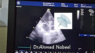 VSD OCCLUDER by an echocardiography insitu 🫀 hearthealth echocardiogram echocardiography heart [upl. by Maram]