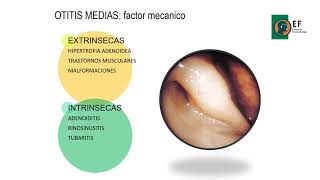 Otitis medias con efusión [upl. by Tilda]