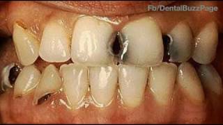 GV Blacks Classification of Dental Caries [upl. by Annaitat]