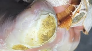 Pedicure video25，vertical plantaris，plantar wart [upl. by Scurlock]