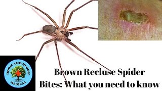 Brown Recluse Spider Bites What you need to know [upl. by Hilliary]